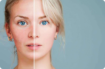 Soluții pentru combaterea iritației și roșeții de pe față